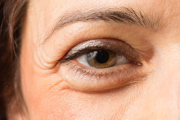 Göz Torbalarının Oluşum Nedenleri - İstanbul Göz Hastalıkları Kliniği