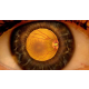 retina-dekolmaninda-tedavi-yontemleri